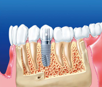 Системы имплантации зубов