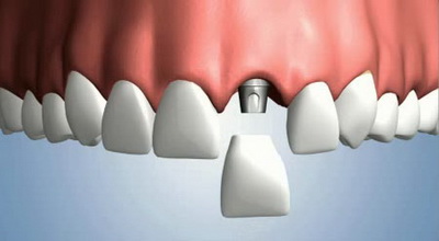 Имплантация зубов или протезирование зубов?