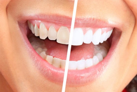 Отбеливание зубов: дома или в клинике